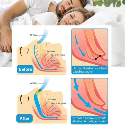 Anti-Snoring Corrector Snore Prevention Gadget Women'S Anti-Snore Device Snore Elimination Nose Clip Men'S Sleep Night
